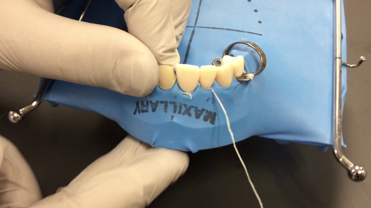 Self Ligating Floss Ligature YouTube