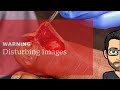 DIABETIC SEROMA TOE INFECTION - GRAPHIC CONTENT