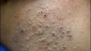 Deep Pore Cleansing for Acne and Blackheads | Satisfying Extraction!