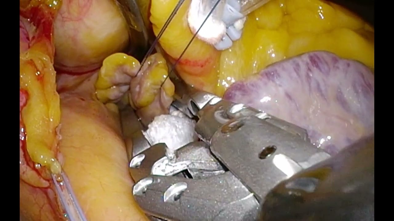 AtriClip PRO2 Dr  Van Praet Frank  primeur België