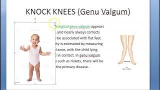 Orthopedics 343 Genu Valgum Knock knee