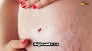 How does Cocoa Butter Remove Stretch Marks?
