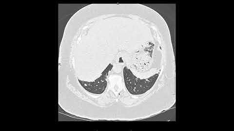 Organizing pneumonia secondary to myositis
