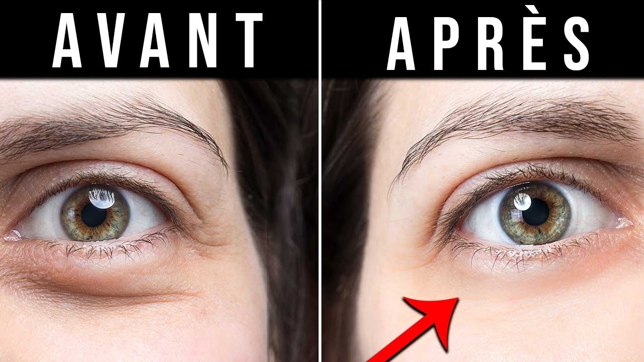 KIT ANTI CERNES Efficace : lequel choisir ? en 2022