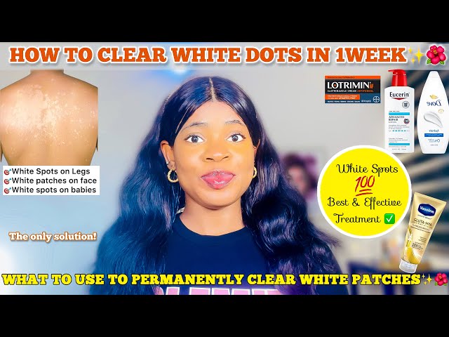 HOW TO GET RID OF WHITE DOTS ON SKIN ✓ Effective Treatment for White Patches  on Skin & Best Products