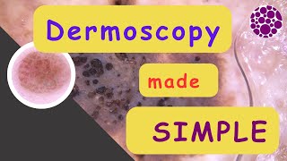 Dermoscopy made simple