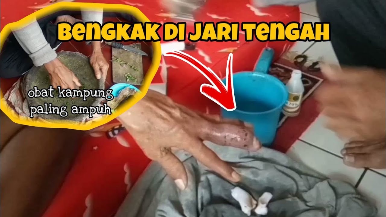 CARA MENGOBATI JARI BENGKAK SEPERTI INI DENGAN OBAT ALAM 