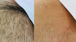 Depilação Sem Cera Sem Dor Em 5 Minutos