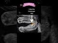 Ultrasound scan showing baby girl shorts