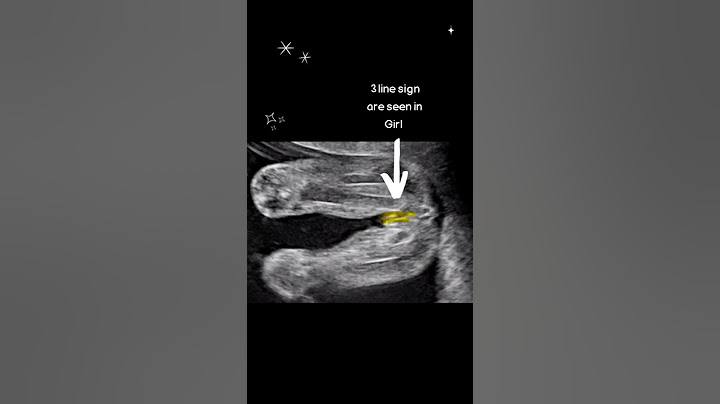 Ultrasound Scan Showing Baby Girl🎀 #shorts