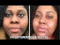 HYPERPIGMENTATION SKINCARE ROUTINE UPDATE 2020