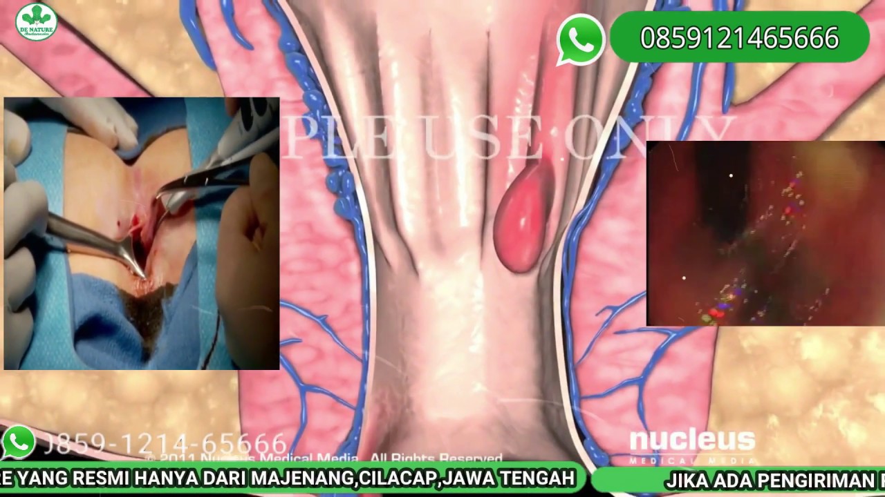 cara mengobati wasir agar cepat kempes