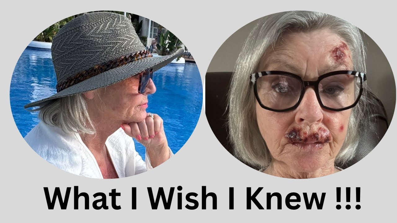 «Повреждения кожи от солнца после 50: моя история актинического кератоза»