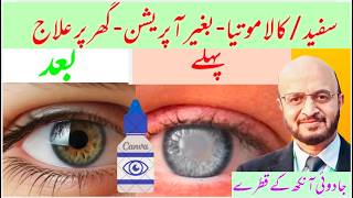 Reverse Cataracts/ Glaucoma  Naturally with This Daily Fermented Antioxidant Shake + magic Eye Drops