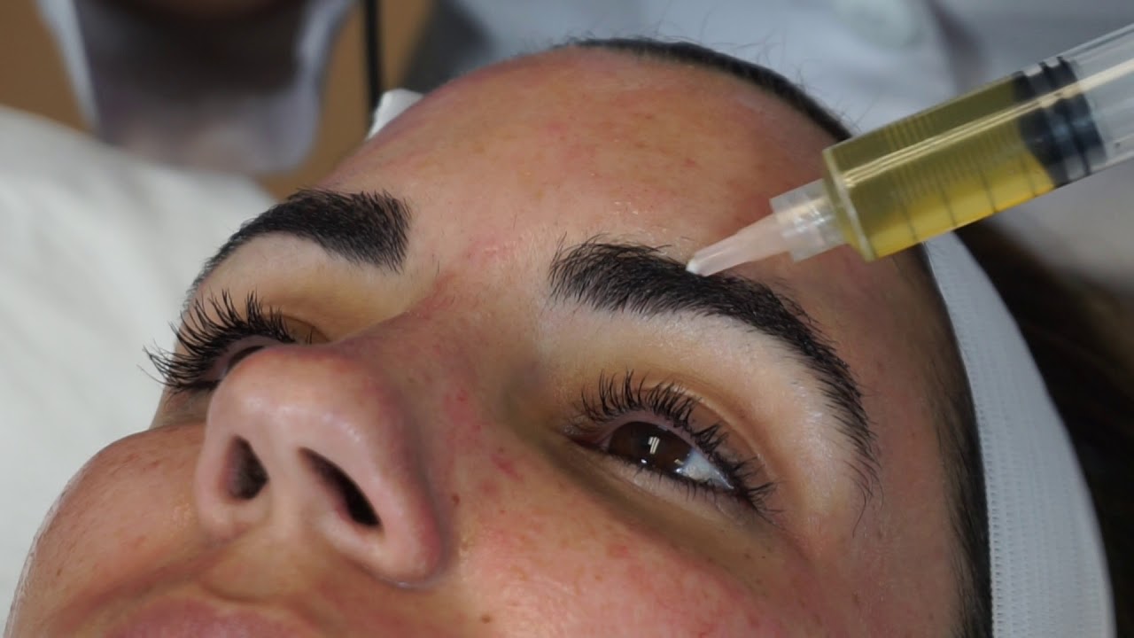 PRP to enhance eyebrow growth YouTube