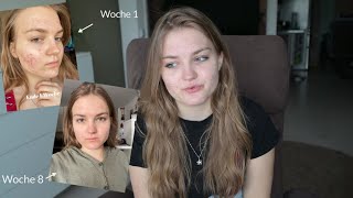 Schon Nach 2 Monaten Keine Pickel Mehr ?Aknenormin Tagebuch - 2 Monat Isotretinoin Update