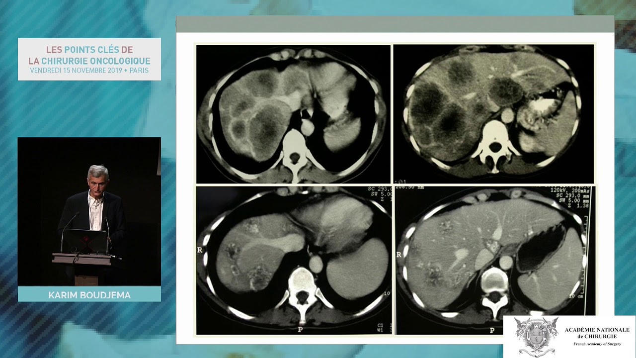 La chirurgie métastatique du foie n’est plus une situation palliative
