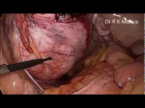 Laparoscopic Myomectomy HD Video For Multiple Myoma Using Mishra's Knot