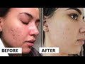 CHEMICAL PEEL FOR ACNE RESULTS | 3 MONTH VLOG