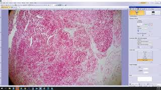 Melanoma (predominant nodular growth).