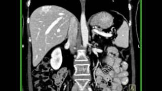 Abdomen Liver Av Malformation Evidence Of A Hypervascular Lesion In The Dome Of The Liver5 Of 5