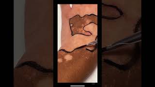 I turned my vitiligo into art…