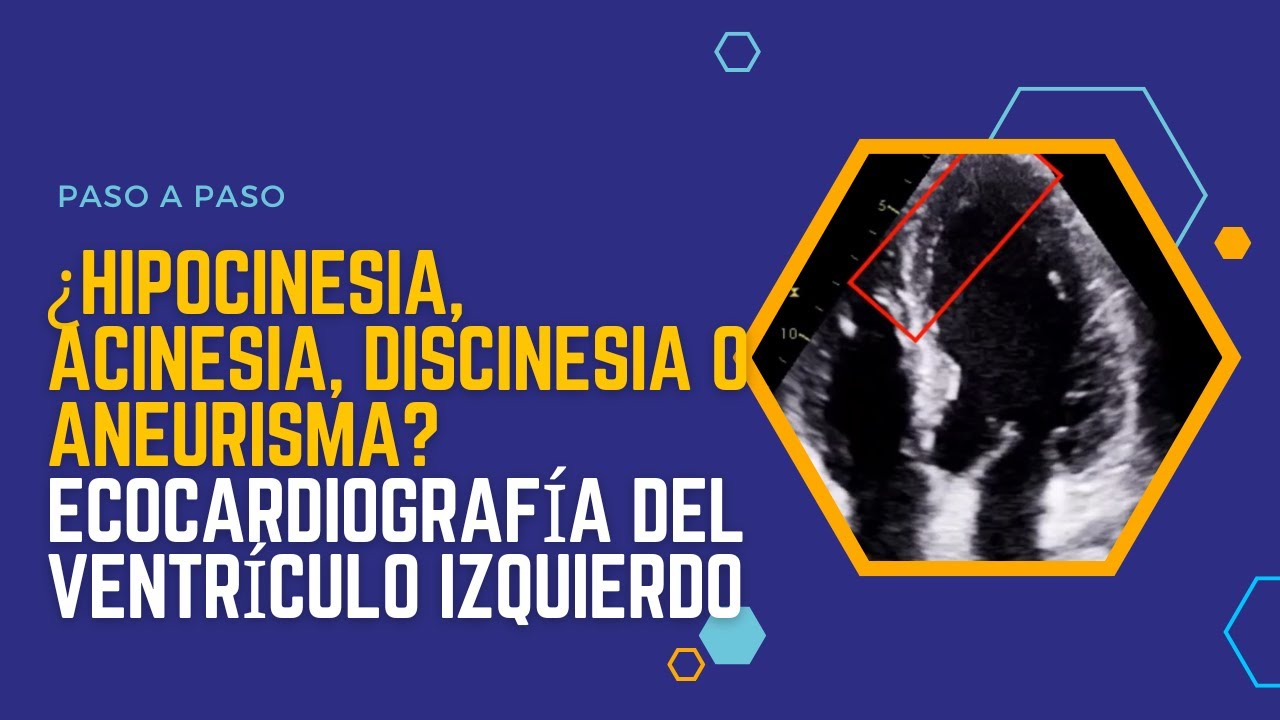 ✅¿Hipocinesia, Acinesia, Discinesia o Aneurisma? Ecocardiografía del Ventrículo Izquierdo🚀