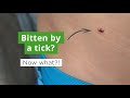 How to Remove a Tick | What To Do if You Get Bitten by a Tick