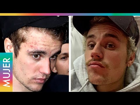 Video: Justin Bieber No Puede Deshacerse Del Acné