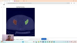 Bone vision - Pelvic fracture detection and Segmentattion