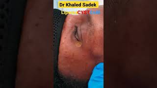 #pimplepopper #blackheads #cystremoval #drkhaledsadek Dr Khaled Sadek Lipomacyst.com