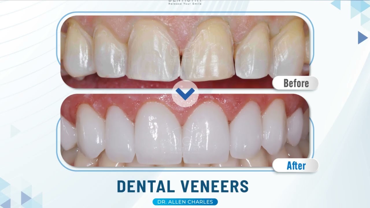 Dentist Office & Emergency Care in Dallas: Implants, Cleanings, Wisdom Teeth & More