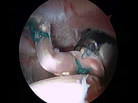 Trasplante labrum camera iphone 8 plus apk