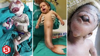 Dokter Sangat Syok Ketika Bayi ini Lahir Berbentuk Tidak Lazim, Dari Berkaki Duyung Sampai Gurita
