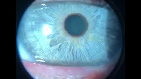 The video was taken by Phonto Image module for slit lamp