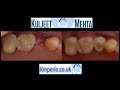 Flapless Dental Implant -Upper Right Premolar