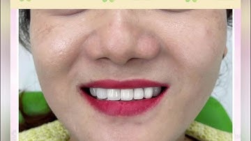 Thiết kế lại răng hàm trên thay đổi nụ cười rạng rỡ tại Nha khoa Thiện An