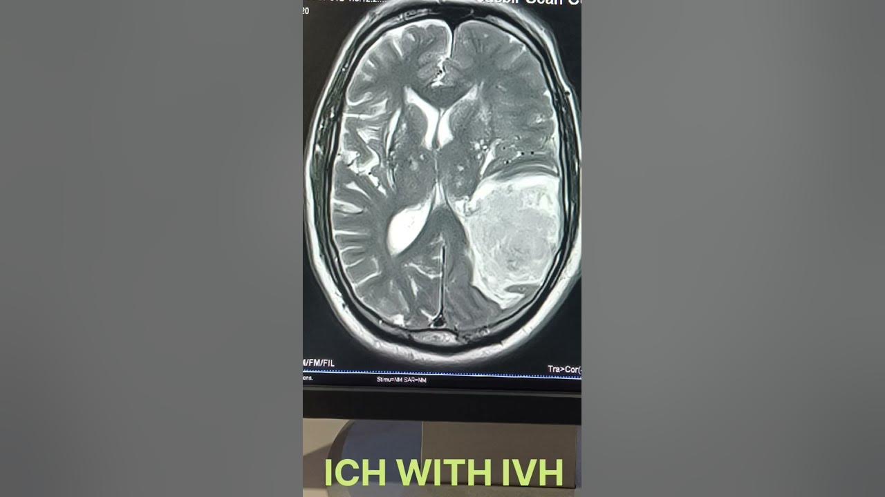 acute-ich-with-ivh-in-mri-all-sequences-like-and-subscribe-for-more