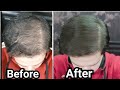 How to Use Rosemary Oil for Hair Growth, Baldness, Hair Loss, Thinning Hair (My Results w/ Pictures)