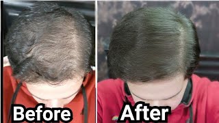How to Use Rosemary Oil for Hair Growth, Baldness, Hair Loss, Thinning Hair (My Results w/ Pictures)