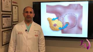 Prof Dr Fatih Aydoğan Mastektomi