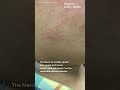 Florida measles cases rise to 132, report shows