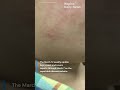 Florida measles cases rise to 132, report shows