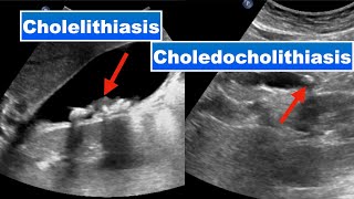 Cholelithiasis and choledocholithiasis I Ultrasound