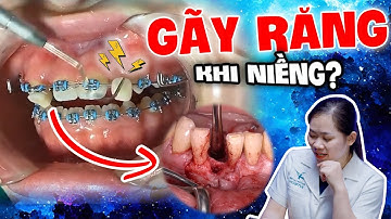 Niềng Răng Có Làm Răng Yếu Đi Không: Top 3 Nguyên Nhân "Cực Nguy Hiểm" Có thể Làm Răng Yếu Đi!