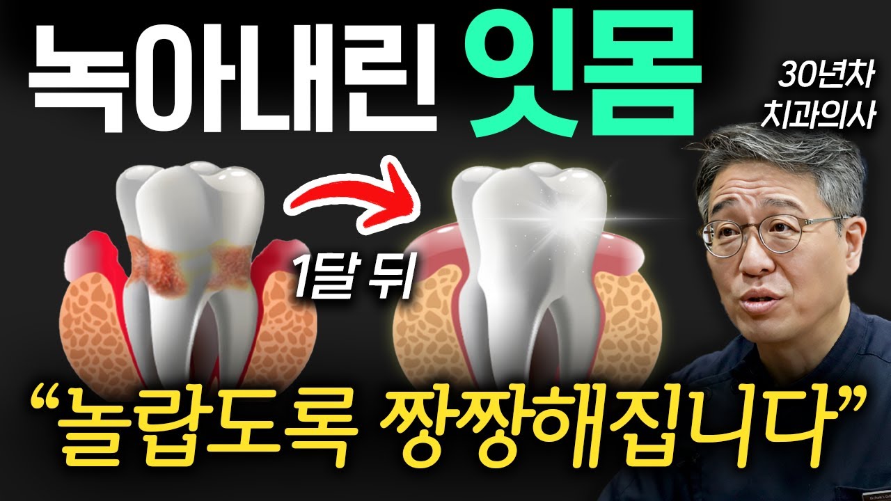 내려앉고 피가 나는 잇몸을 위한 가장 확실한 치료 방법 (박창진 원장 2부)