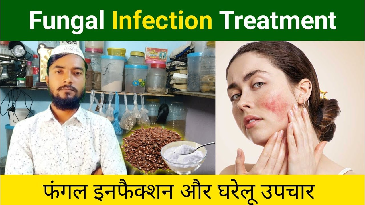 Fungal infection Treatment | Fungal Ke Lakshan Aur Upaye || Fungal Kiya ...