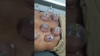 How to use cupping therapy to lower back pain || How to apply Cupping Therapy #cupping