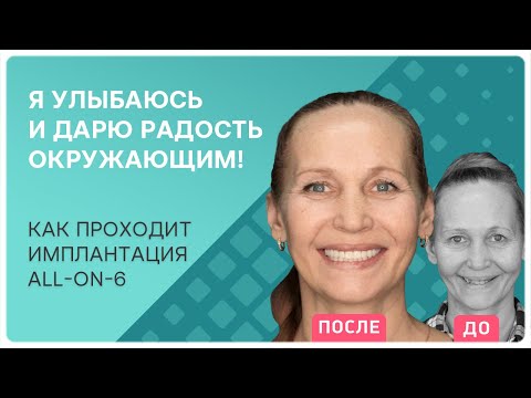 Все этапы имплантации