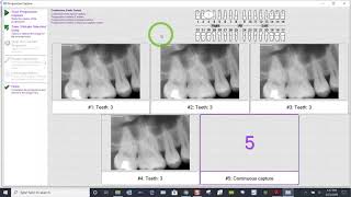 Training: XVWeb 2.0 - Acquiring a Continuous Endo Series in XVCapture